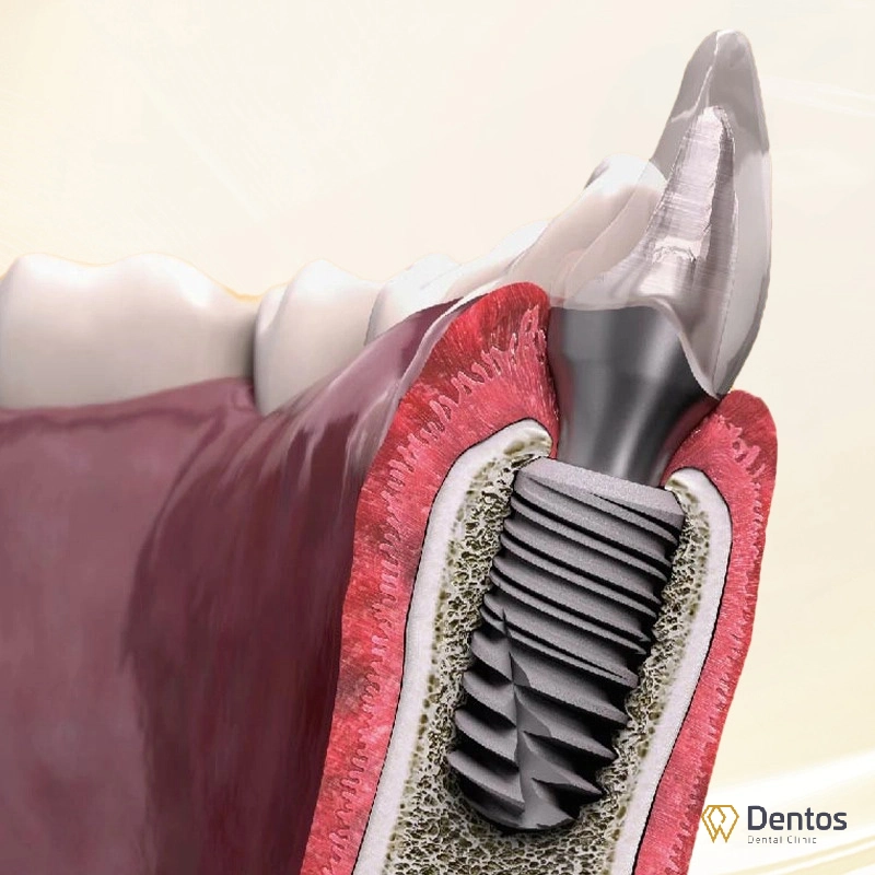 Kết nối In-Kone® Morse Taper 8° độc quyền